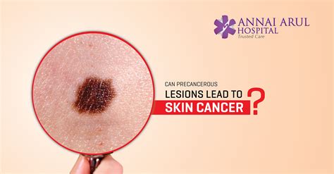 Read about the possible risks here. CAN PRECANCEROUS LESIONS LEAD TO SKIN CANCER ...