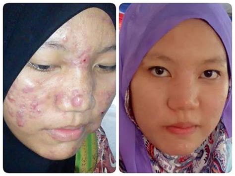 We did not find results for: Ubat Jerawat Di Badan - Contoh Raffa