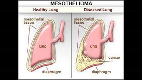 We did not find results for: mesothelioma symptoms - YouTube