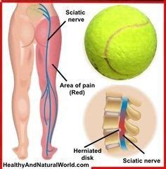 The two sciatic nerves are the longest nerves found in the body. Learn how to do tennis ball therapy which helps to relieve ...