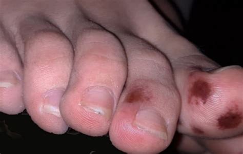 Coronavirus cases and hospitalizations have been on a major decline since their peak numbers from. Doctors say they're inundated with calls about COVID toes ...