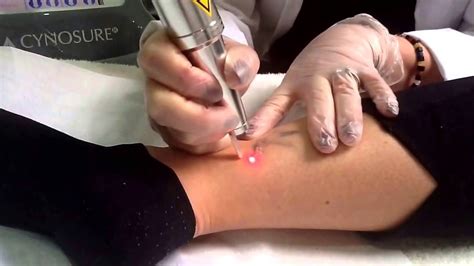 Yag laser can be used to remove red pigments, the 1064 nm nd: Laser Tattoo Removal UK - Q-Switched Nd:Yag Laser ...