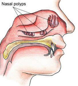 Nasal polyps usually grow in the shape of a teardrop. Non Allergic Rhinitis | Symptoms, Causes & Best Treatment