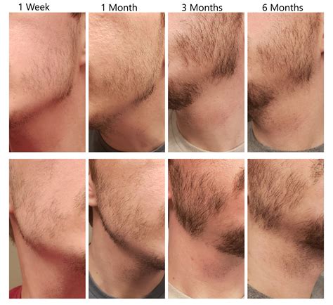 After this period, you will most likely encounter phases of shedding and stagnation, and then spikes in growth. Minoxidil Before And After Beard Result : Minoxidil Rogaine For Beard Growth For Fuller And ...