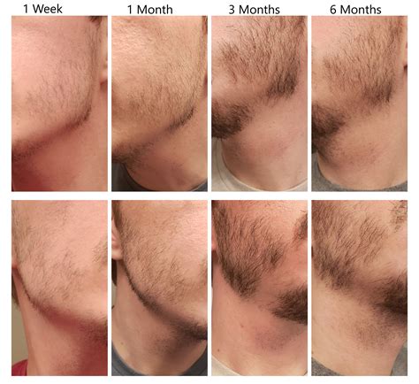 Minoxidil Before And After Beard Result : Minoxidil Rogaine For Beard Growth For Fuller And ...
