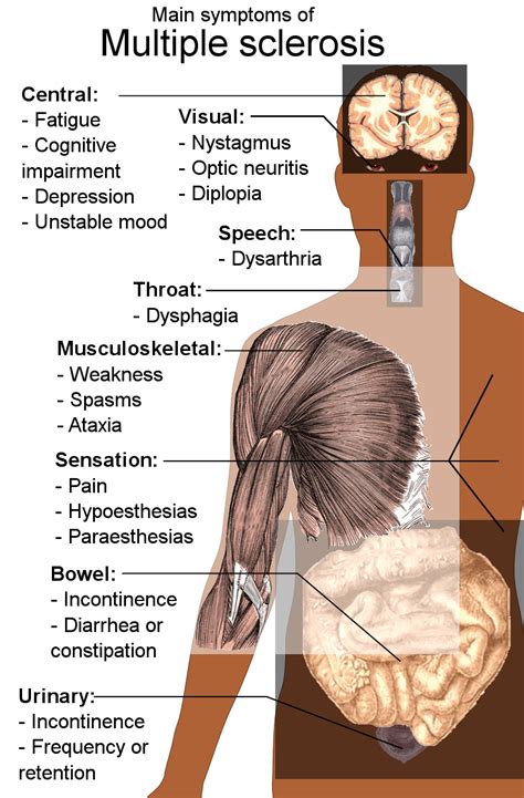 Multiple sclerosis has a fascinating geographic distribution: MS symptoms, causes and treatments - Harrow MS Therapy Centre