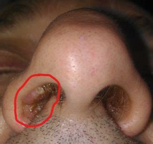 The nose is one of the most sensitive organs in the body. Papilloma of nasal vestibule. Romanian Journal of Rhinology