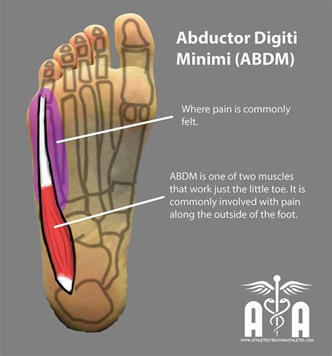 Abductor digiti minimi (foot pain symptoms). abductor digiti minimi foot - Google Search | Anatomy and ...
