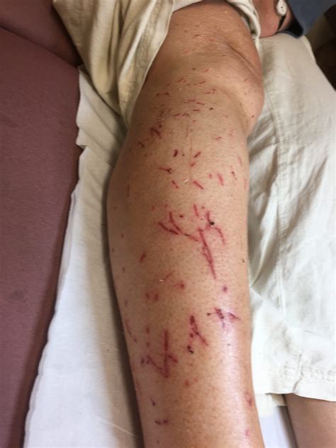 Podiatry and Cat Scratch Fever - Kittens are Dangerous ...