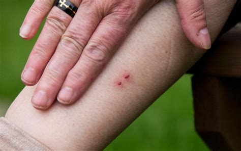 A snakebite is an injury caused by the bite of a snake, especially a venomous snake. Shopper bitten by 'escaped snake' in Worcester