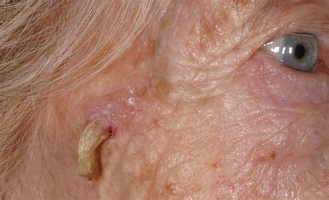 Not everyone is that this cutaneous horn and how it looks. Cutaneous horn causes, symptoms, cancer & cutaneous horn ...