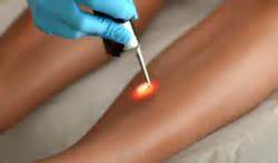 Laser hair removal is considered a medical treatment, and just like all other medical treatments, it carries the risk of possible side effects. New Laser Hair Removal Technology Reduces Side Effects and ...