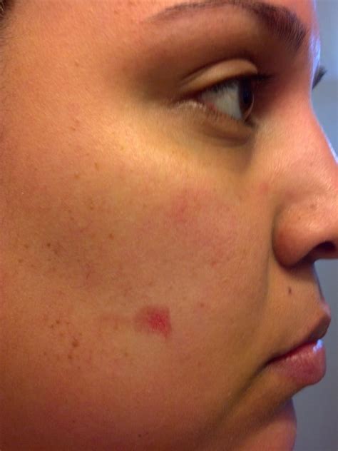 A melbourne woman has been left burnt, blistered and close to a $1,000 out of pocket after laser hair removal went horribly wrong. Burn on my right cheek after receiving laser hair removal ...