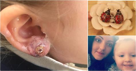 How long it will take to heal. Mother's anger after £2.99 piercing on daughter, 3, became ...