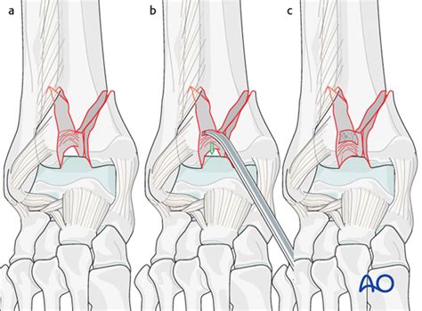 ORIF - Plate and screws through anterolateral approach for ...