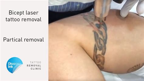 Tattoo cares has put together this 5 step guide to help you understand exactly what to expect from tattoo removal. Laser Tattoo Removal - A Partial Removal - YouTube