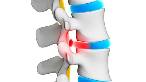 It is sometimes called a bulging, protruding, or ruptured disk. 6 Best Exercises for Disc Herniation Sciatica : Physiosunit