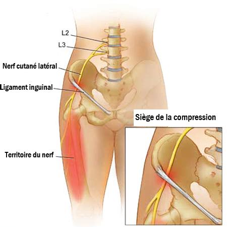 Méralgie paresthésique : causes, symptômes et traitement