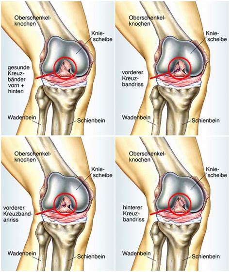 Was sie dagegen tun können und was hinter den beschwerden stecken könnte, finden sie in diesem artikel. Kreuzbandriss - Kreuzband Verletzung - Kreuzbandoperation