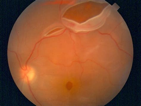 A retinal detachment of this type is known as a rhegmatogenous retinal detachment. Retina (ARMD) and Vitreous - The ELZA Institute