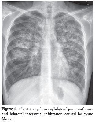 This is partly because the lungs are often severely affected and the cause of significant morbidity and mortality. Simultaneous bilateral spontaneous pneumothorax in an ...