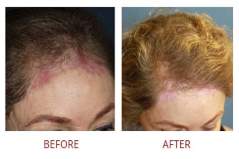 Hair loss in women, causes and treatment. Female Hair Transplant Photos - Beverly Hills Hair ...