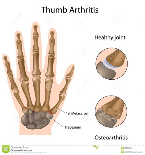 Les articulations synoviales autorisent plus de mobilit que les disques. Arthrite de pouce illustration de vecteur. Illustration du ...