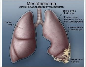 The mesothelioma victims center is now offering a free vital service that is designed to increase the financial compensation for a person with mesothelioma. Mesothelioma Victims Center | The Premier Mesothelioma ...