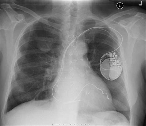 Mesothelioma pathology provides a full picture of the cancer, contributing to a more accurate diagnosis and an informed treatment plan. mesothelioma pathology outlines #Mesothelioma ...