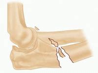 Open Reduction and Internal Fixation of Fractures of the ...