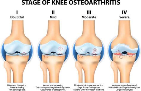 Waktu kemunculan rasa sakit ini. 7 Punca Sakit Lutut Menjadi Masalah Utama di Malaysia!