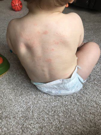 A skin rash, such as hives, along with vomiting and diarrhea, are potential symptoms of a food allergy. Heat rash or allergic reaction? - Page 1 | BabyCenter