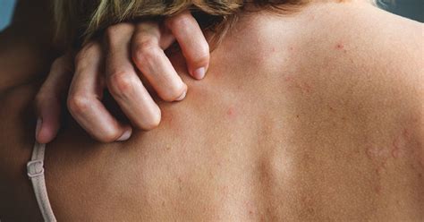 Pictures of skin rashes | lovetoknow. Drug Rash and Eruption: Symptoms, Pictures, Causes, and ...