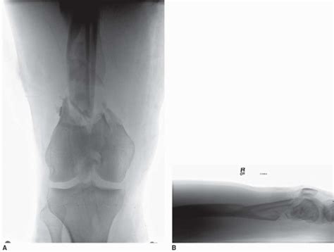 Distal Femur Fractures: Open Reduction and Internal ...