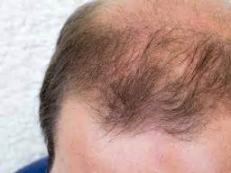 Apart from hormonal changes, hereditary factors can also result in. DHT (dihydrotestosterone): What is DHT's role in baldness?