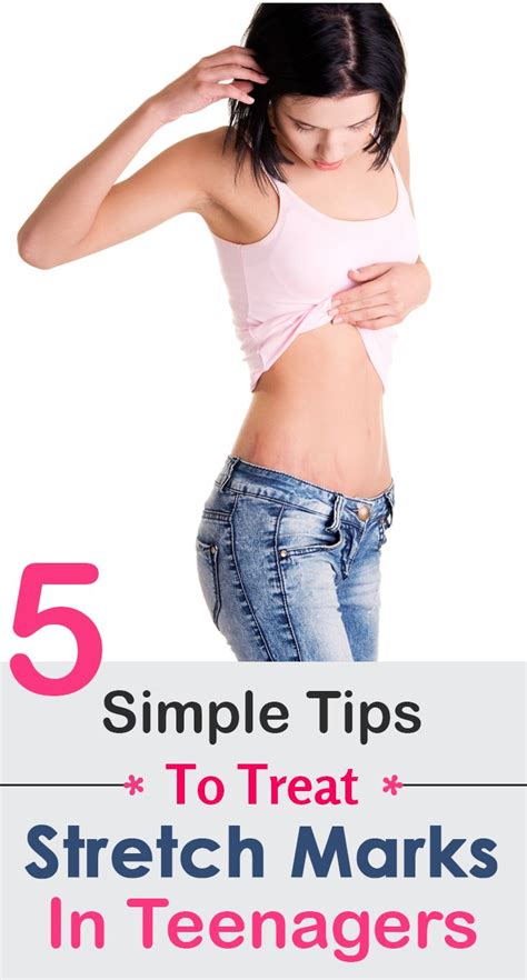 Goldenberg says stretch marks may fade to be practically unnoticeable in some people, but in others they won't. 5 Simple Tips To Treat Stretch Marks In Teenagers ...