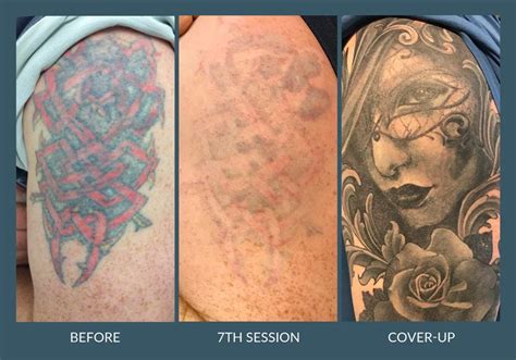 While tattoos are generally considered permanent, it is now possible to remove them with treatments, fully or partially. Laser Tattoo Removal in Leicester - G-Lasers