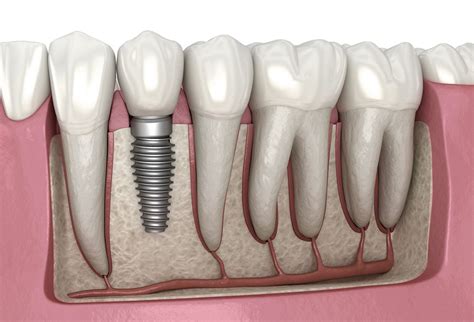 Free dental implants are hard to come by. Dental implant - Wikiwand