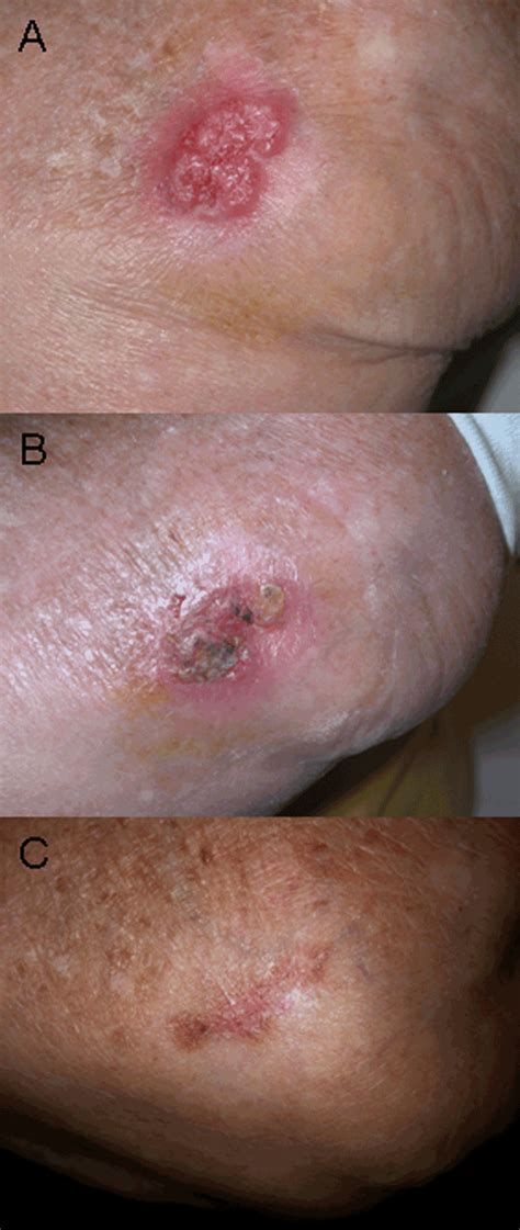 While some infections are subclinical, others result in localized acute or chronic disease, or fatal septicemia. Melioidosis. Causes, symptoms, treatment Melioidosis