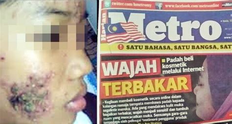 Artikel ini membahas tentang keracunan karena menelan merkuri klorida. Jangan Bangga Sangat Muka Cantik,Pakai Produk Merkuri,Awas ...