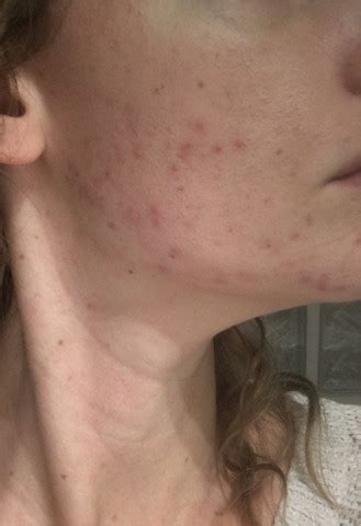 Diese kategorie sammelt artikel zu erkrankungen der haut und der hautanhangsgebilde (außer der weiblichen brust) des menschen.erkrankungen, die zwar in der dermatologie behandelt werden, aber selber nicht die haut betreffen kommen in die oberkategorie:krankheitsbild in der dermatologie, artikel zu sexuell übertragbaren erkrankungen kommen in die kategorie:sexuell übertragbare erkrankung Ist das wirklich Akne? (Gesundheit und Medizin, Haut, Pickel)