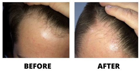 Hair loss prevention and treatment may involve minoxidil (rogaine) or finasteride (propecia). Hair loss treatment , minoxidil , propecia, natural ...