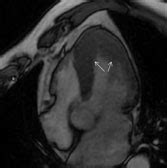 La ressonància magnètica és indolora i no és invasiva. Avaliação das cardiomiopatias - A contribuição da ...