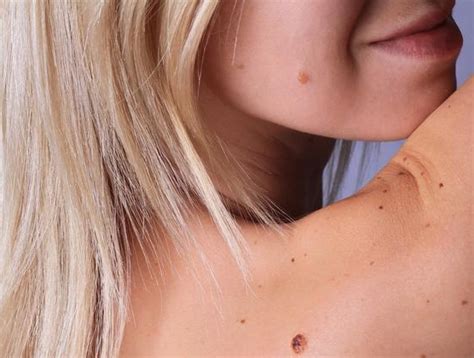 Tindakan ini berbahaya dan bisa merusak jaringan kulit. Hilangkan Tahi lalat Dengan 5 Cara Alami - studiofourb.com