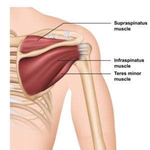 Supraspinatus tear exercises can help you recover from injury, but there are also rotator cuff exercises to avoid when you suffer from this condition. Rotator Cuff Tears: Non-Surgical Management with Exercise