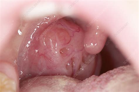 You can't monitor their every step, because a potential danger. Enlarged tonsil of a 12 year old - Stock Image - M270/0298 ...