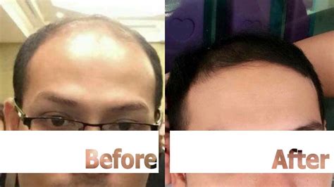 One of the main reasons i feel that my thin, fine hair has truly thickened is because of viviscal maximum strength tablets. I Went from Thin to Thick Hair in Just a 2-3 months By Neo ...
