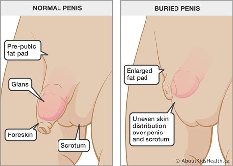 Pictures help to evaluate your donation quicker. How to get rid of fat around my pubic area MISHKANET.COM