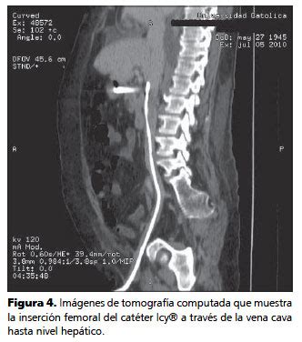 3 de mayo de 2009 a las :03. Trombosis venosa mayor asociada a catéter de hipotermia ...