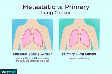 Occasionally dogs and cats with lung cancer are lame. Metastatic Cancer to the Lungs: Symptoms and Treatment